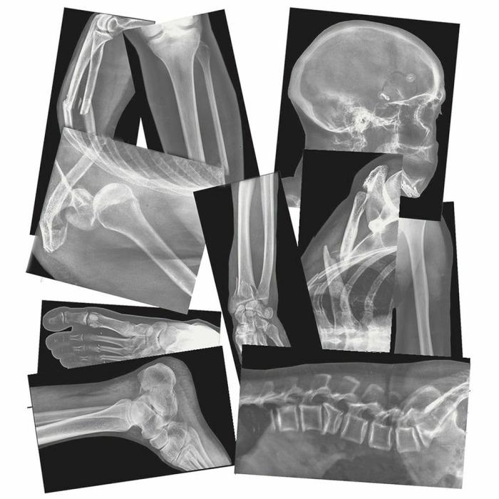 Puzzles |   Broken Bones X-Rays